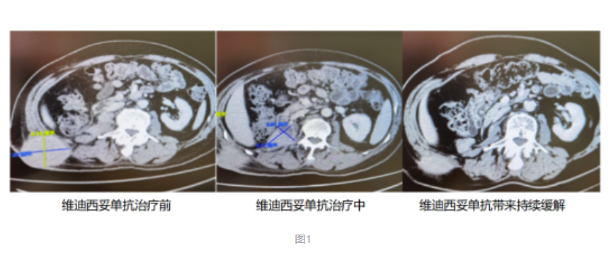 效果显著更安全，维迪西妥单抗已成为HER2胃癌治疗新选择